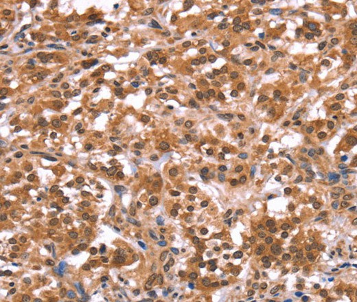 Immunohistochemistry of paraffin-embedded Human thyroid cancer tissue using AMER1 Polyclonal Antibody at dilution 1:40