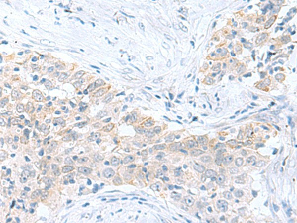 Immunohistochemistry of paraffin-embedded Human esophagus cancer tissue  using PDE6D Polyclonal Antibody at dilution of 1:60(?200)