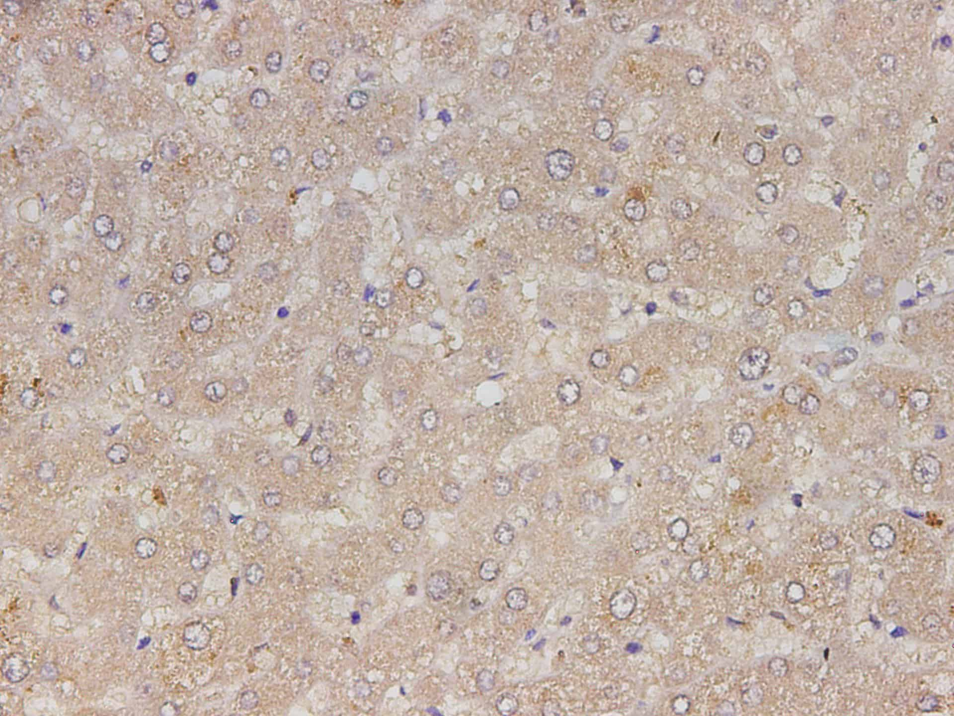 Immunohistochemistry of paraffin-embedded Human liver cancer tissue using RETN Polyclonal Antibody at dilution of 1:150(?400)