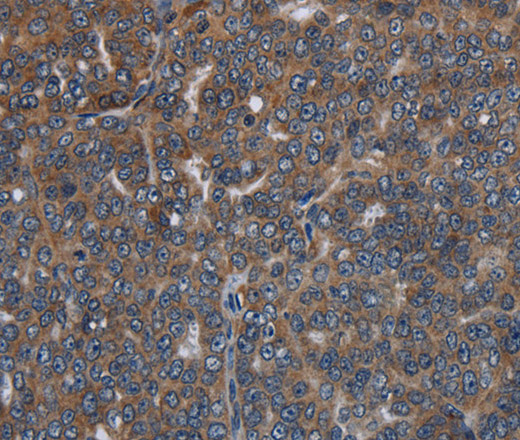 Immunohistochemistry of paraffin-embedded Human ovarian cancer tissue using LETMD1 Polyclonal Antibody at dilution 1:30