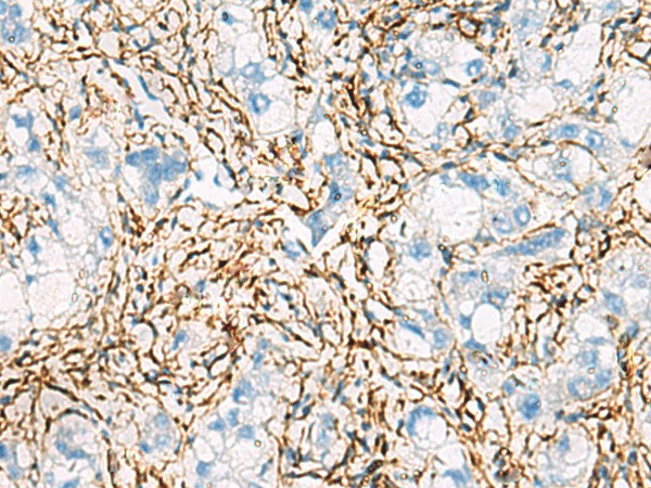 Immunohistochemistry of paraffin-embedded Human liver cancer tissue  using ACTC1 Polyclonal Antibody at dilution of 1:55(?200)