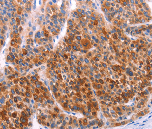 Immunohistochemistry of paraffin-embedded Human liver cancer using AADAC Polyclonal Antibody at dilution of 1:30