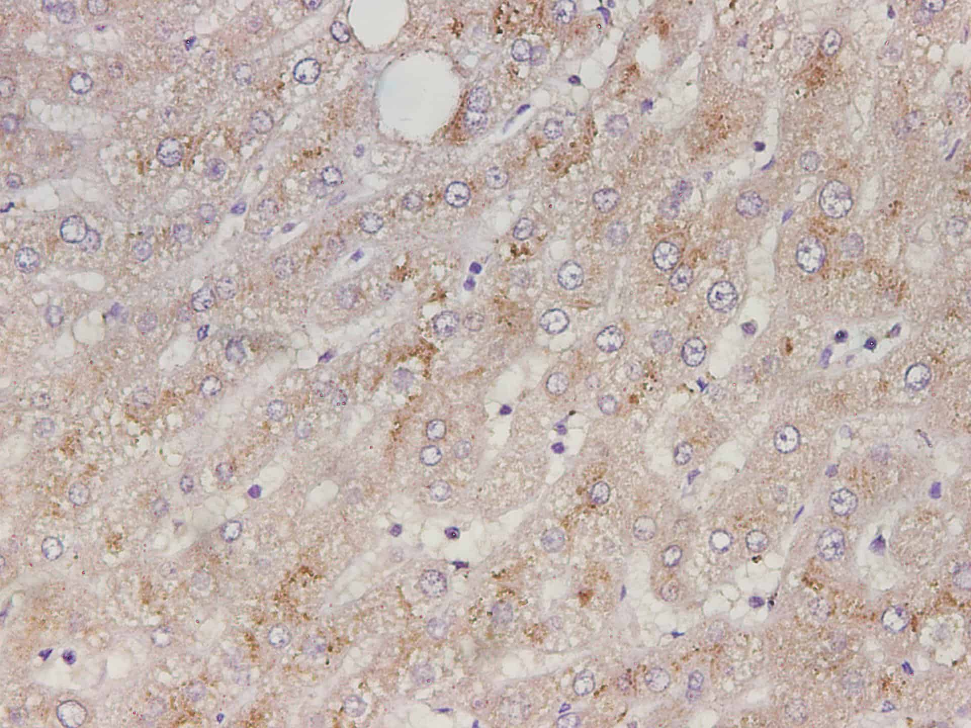 Immunohistochemistry of paraffin-embedded Human liver tissue using Serpin A1 Polyclonal Antibody at dilution of 1:3500(?400)