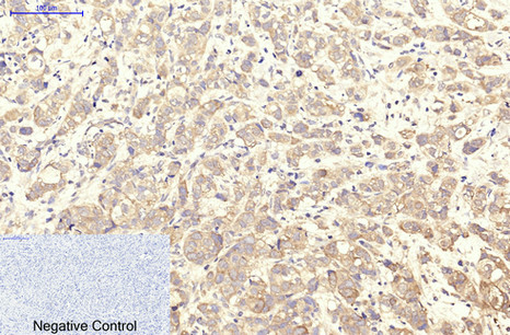 Immunohistochemistry of paraffin-embedded Human breast cancer tissue using ITGA2B Monoclonal Antibody at dilution of 1:200.