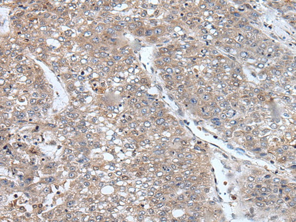 Immunohistochemistry of paraffin-embedded Human liver cancer tissue  using BORA Polyclonal Antibody at dilution of 1:105(?200)