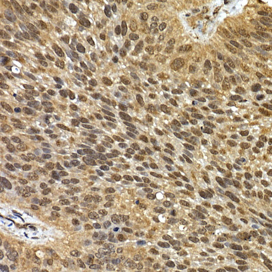 Immunohistochemistry of paraffin-embedded human lung cancer using SQSTM1/p62 Polyclonal Antibody at dilution of 1:100 (40x lens).Perform high pressure antigen retrieval with 10 mM citrate buffer pH 6.0 before commencing with IHC staining protocol.