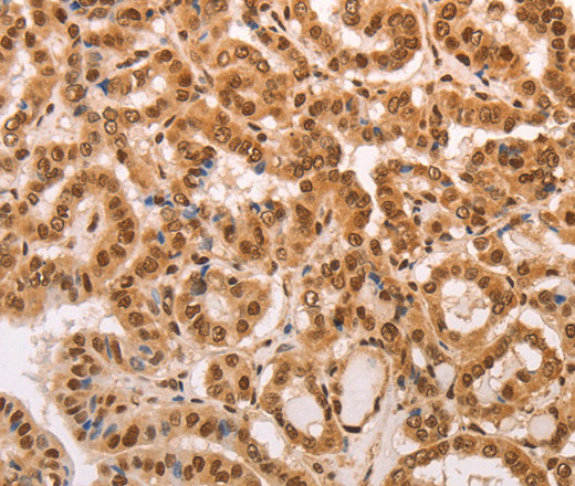 Immunohistochemistry of paraffin-embedded Human thyroid cancer tissue using HEXIM1 Polyclonal Antibody at dilution 1:65