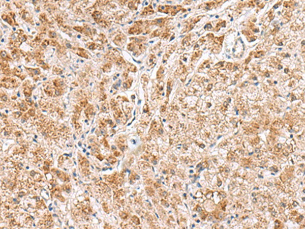 Immunohistochemistry of paraffin-embedded Human liver cancer tissue  using HMGCLL1 Polyclonal Antibody at dilution of 1:60(?200)