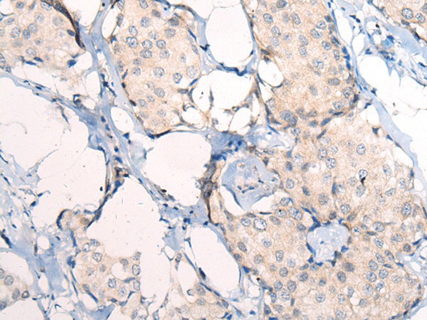 Immunohistochemistry of paraffin-embedded Human breast cancer tissue  using ANAPC15 Polyclonal Antibody at dilution of 1:50(?200)