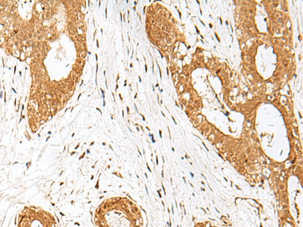 Immunohistochemistry of paraffin-embedded Human breast cancer tissue  using IPO11 Polyclonal Antibody at dilution of 1:70(?200)