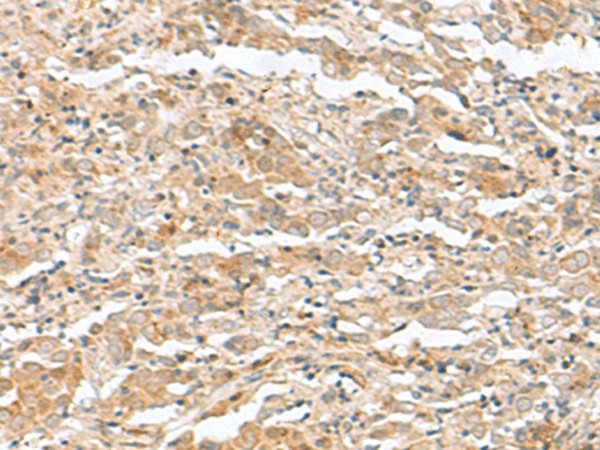 Immunohistochemistry of paraffin-embedded Human cervical cancer tissue  using TTC12 Polyclonal Antibody at dilution of 1:40(?200)