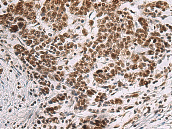 Immunohistochemistry of paraffin-embedded Human colorectal cancer tissue  using CREBBP Polyclonal Antibody at dilution of 1:60(?200)