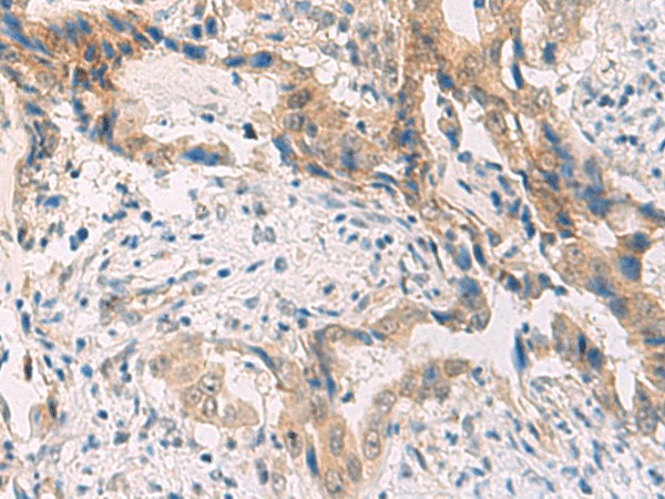 Immunohistochemistry of paraffin-embedded Human cervical cancer tissue  using PCYT2 Polyclonal Antibody at dilution of 1:55(?200)