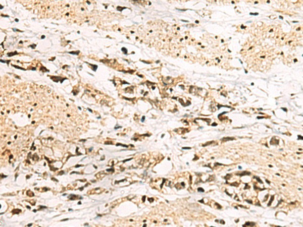 Immunohistochemistry of paraffin-embedded Human gastric cancer tissue  using LRIF1 Polyclonal Antibody at dilution of 1:70(?200)