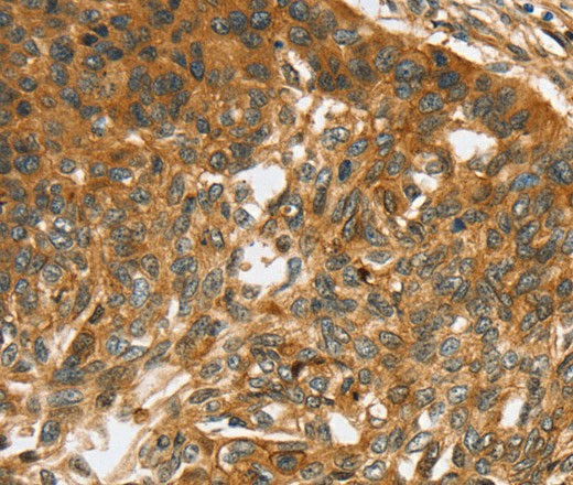 Immunohistochemistry of paraffin-embedded Human esophagus cancer using TNFSF15 Polyclonal Antibody at dilution of 1:40