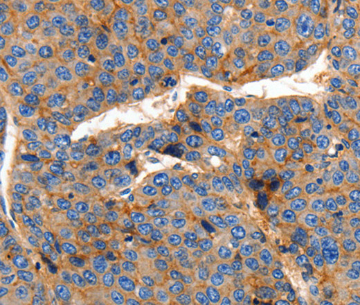 Immunohistochemistry of paraffin-embedded Human liver cancer using Claudin 1 Polyclonal Antibody at dilution of 1:150