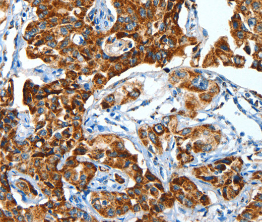 Immunohistochemistry of paraffin-embedded Human lung cancer using ALDH6A1 Polyclonal Antibody at dilution of 1:45