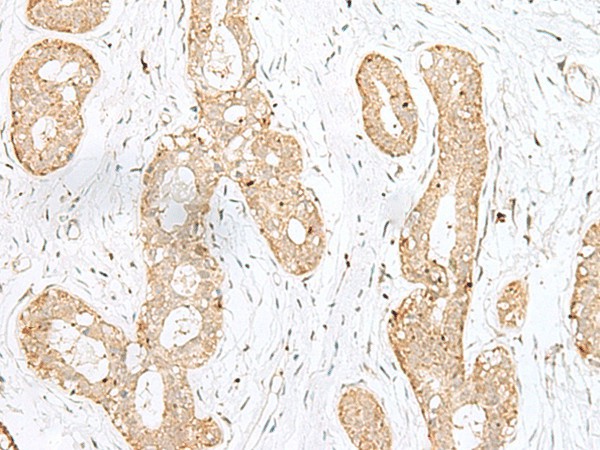 Immunohistochemistry of paraffin-embedded Human breast cancer tissue  using BEX2 Polyclonal Antibody at dilution of 1:45(?200)