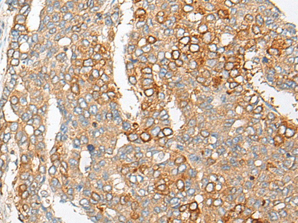 Immunohistochemistry of paraffin-embedded Human liver cancer tissue  using PCDHGB5 Polyclonal Antibody at dilution of 1:35(?200)