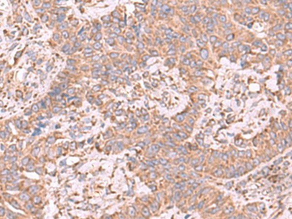 Immunohistochemistry of paraffin-embedded Human ovarian cancer tissue  using EEF1D Polyclonal Antibody at dilution of 1:65(?200)