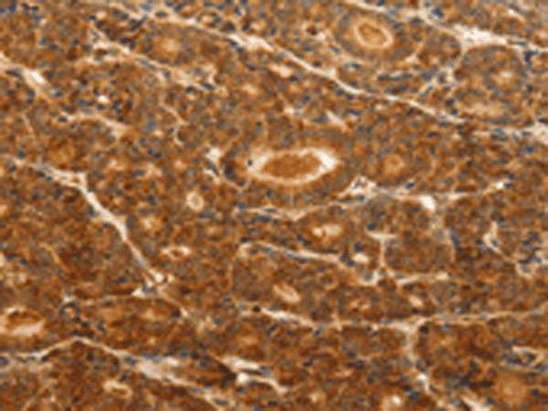 Immunohistochemistry of paraffin-embedded Human thyroid cancer tissue  using CDH5 Polyclonal Antibody at dilution of 1:30(?200)