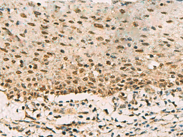 Immunohistochemistry of paraffin-embedded Human cervical cancer tissue  using PHF5A Polyclonal Antibody at dilution of 1:90(?200)