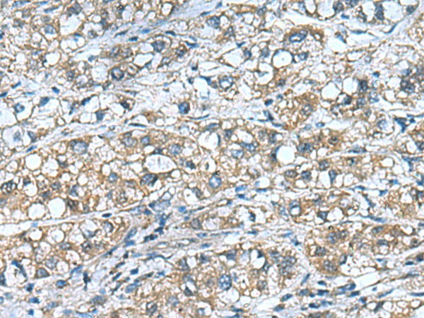 Immunohistochemistry of paraffin-embedded Human liver cancer tissue  using COMMD9 Polyclonal Antibody at dilution of 1:55(?200)