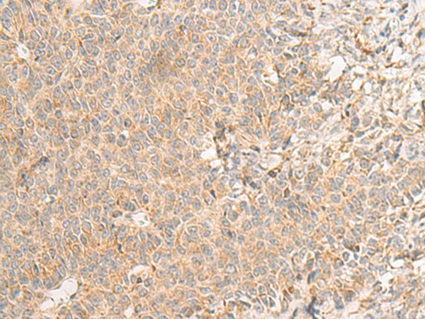 Immunohistochemistry of paraffin-embedded Human ovarian cancer tissue  using RNF207 Polyclonal Antibody at dilution of 1:40(?200)