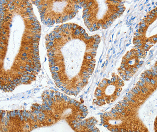 Immunohistochemistry of paraffin-embedded Human colon cancer tissue using MANF Polyclonal Antibody at dilution 1:50