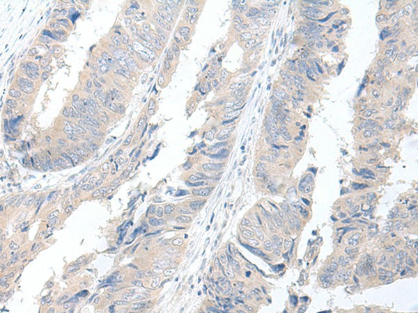 Immunohistochemistry of paraffin-embedded Human colorectal cancer tissue  using GBA2 Polyclonal Antibody at dilution of 1:55(?200)