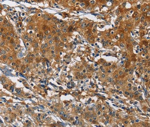 Immunohistochemistry of paraffin-embedded Human gastic cancer using CAST Polyclonal Antibody at dilution of 1:70