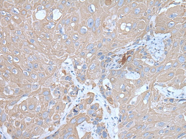 Immunohistochemistry of paraffin-embedded Human esophagus cancer tissue  using IGF2BP3 Polyclonal Antibody at dilution of 1:30(?200)