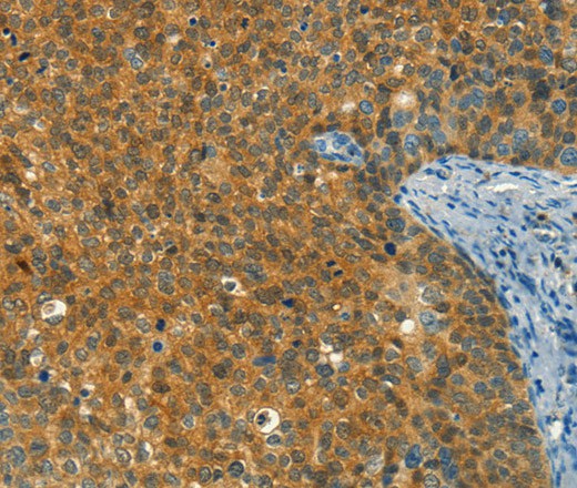 Immunohistochemistry of paraffin-embedded Human cervical cancer tissue using DIRAS1 Polyclonal Antibody at dilution 1:30