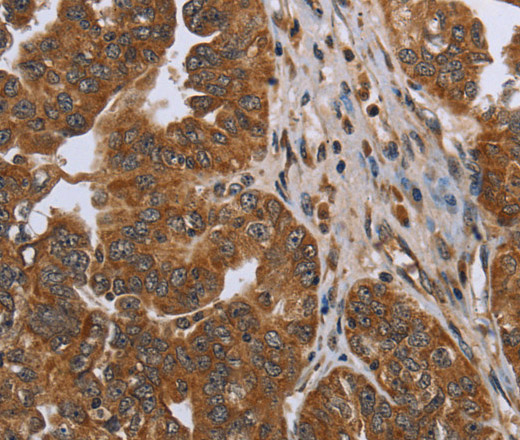 Immunohistochemistry of paraffin-embedded Human ovarian cancer using NDUFAF4 Polyclonal Antibody at dilution of 1:50