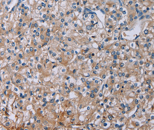 Immunohistochemistry of paraffin-embedded Human prostate cancer tissue using PLXND1 Polyclonal Antibody at dilution 1:40