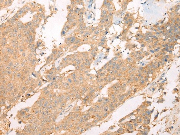 Immunohistochemistry of paraffin-embedded Human colorectal cancer tissue  using ASIC3 Polyclonal Antibody at dilution of 1:40(?200)