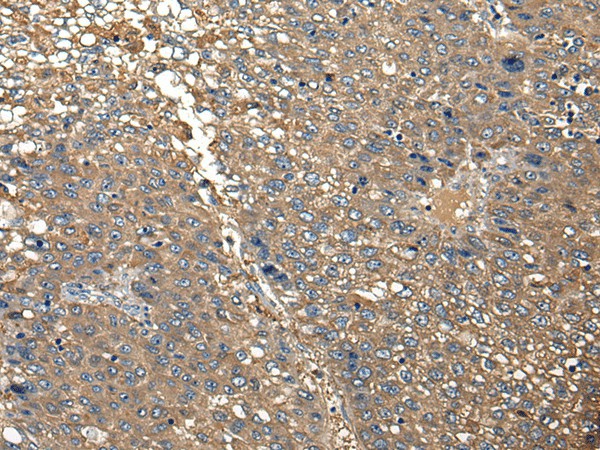 Immunohistochemistry of paraffin-embedded Human liver cancer tissue  using DGKI Polyclonal Antibody at dilution of 1:30(?200)