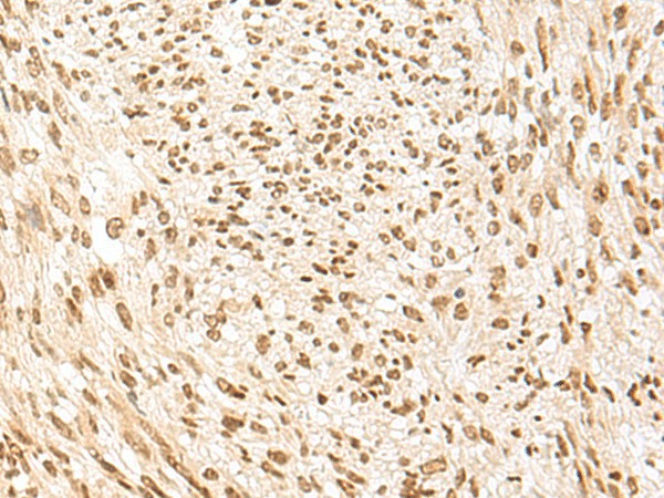 Immunohistochemistry of paraffin-embedded Human liver cancer tissue  using POM121 Polyclonal Antibody at dilution of 1:75(?200)