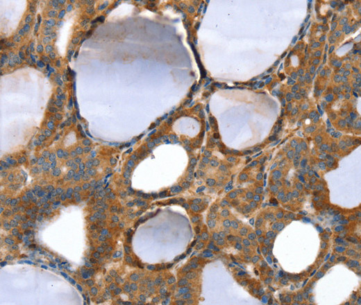 Immunohistochemistry of paraffin-embedded Human thyroid cancer tissue using TAGLN Polyclonal Antibody at dilution 1:30