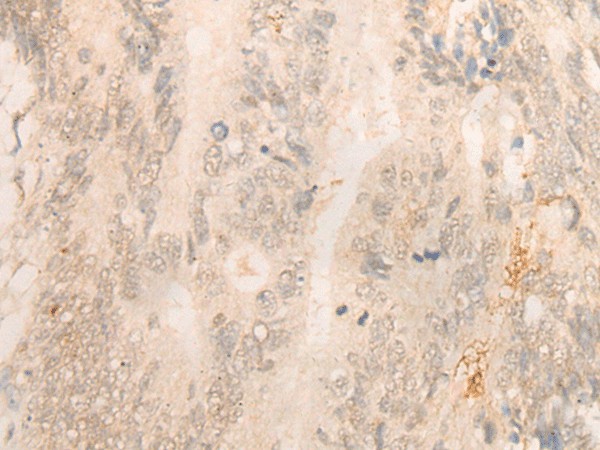 Immunohistochemistry of paraffin-embedded Human colorectal cancer tissue  using FBXO32 Polyclonal Antibody at dilution of 1:35(?200)