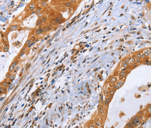 Immunohistochemistry of paraffin-embedded Human cervical cancer using CDK19 Polyclonal Antibody at dilution of 1:70