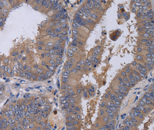 Immunohistochemistry of paraffin-embedded Human colon cancer tissue using MKKS Polyclonal Antibody at dilution 1:50