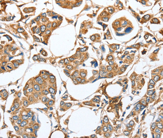 Immunohistochemistry of paraffin-embedded Human breast cancer using CAPG Polyclonal Antibody at dilution of 1:35