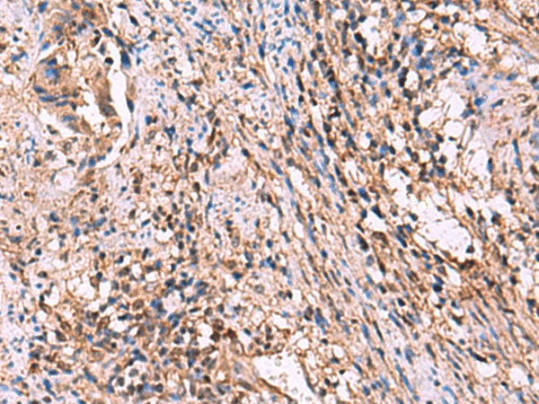 Immunohistochemistry of paraffin-embedded Human cervical cancer tissue  using ITIH4 Polyclonal Antibody at dilution of 1:30(?200)