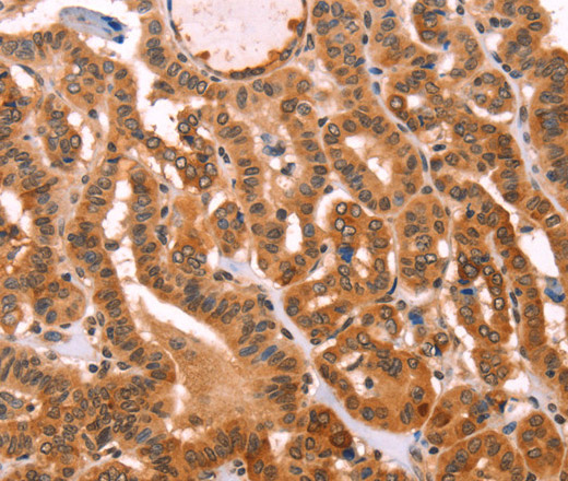 Immunohistochemistry of paraffin-embedded Human thyroid cancer tissue using PROS1 Polyclonal Antibody at dilution 1:40