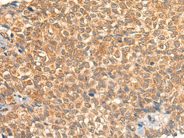 Immunohistochemistry of paraffin-embedded Human ovarian cancer tissue  using UBIAD1 Polyclonal Antibody at dilution of 1:40(?200)