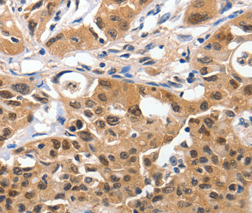 Immunohistochemistry of paraffin-embedded Human lung cancer using 14-3-3 epsilon Polyclonal Antibody at dilution of 1:100