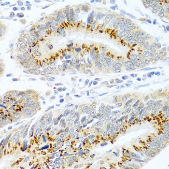 Immunohistochemistry of paraffin-embedded Human colon carcinoma using FAM3B Polyclonal Antibody at dilution of 1:100 (40x lens).