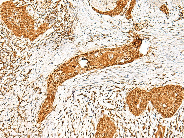 Immunohistochemistry of paraffin-embedded Human esophagus cancer tissue  using PPOX Polyclonal Antibody at dilution of 1:45(?200)