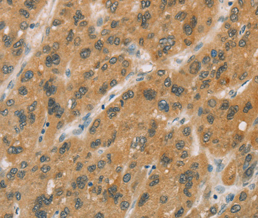 Immunohistochemistry of paraffin-embedded Human liver cancer tissue using CYP11A1 Polyclonal Antibody at dilution 1:50